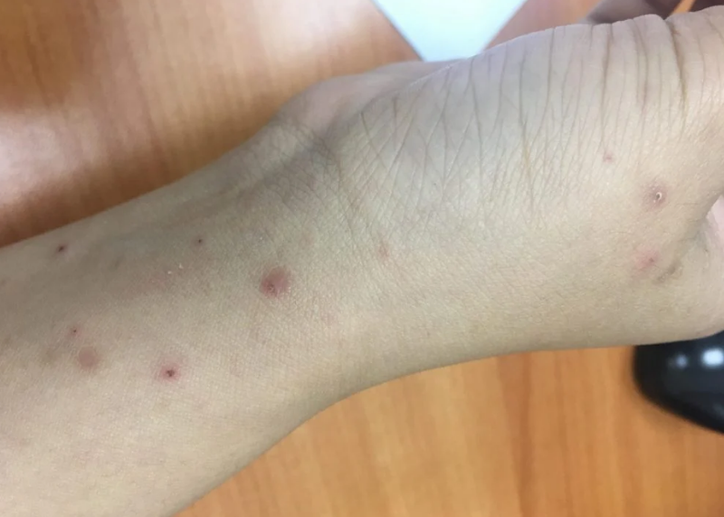 Tăng sắc tố da ở tay là do những nguyên nhân nào? Cách nhận biết? 2