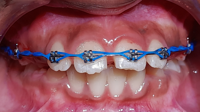 Tìm hiểu giá niềng răng mắc cài kim loại và các yếu tố ảnh hưởng đến chi phí 1