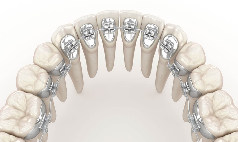 Tìm hiểu giá niềng răng mắc cài kim loại và các yếu tố ảnh hưởng đến chi phí 3
