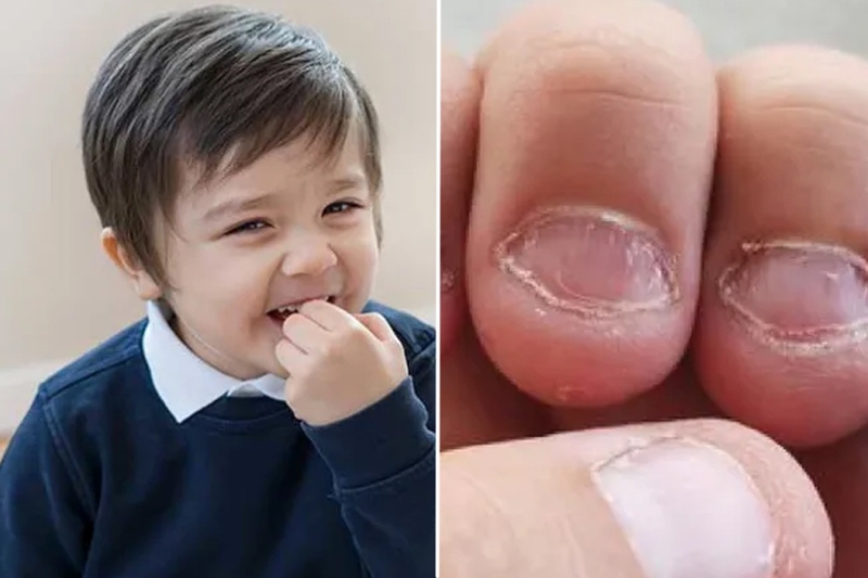 Trẻ hay cắn móng tay là thiếu chất gì? Bổ sung sao cho hiệu quả? 1