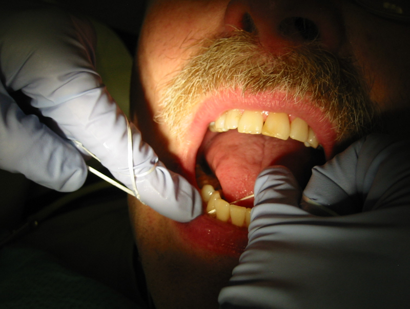 Trồng răng Implant có ăn được thịt gà không? Những lưu ý quan trọng khi ăn thịt gà sau cấy ghép 3