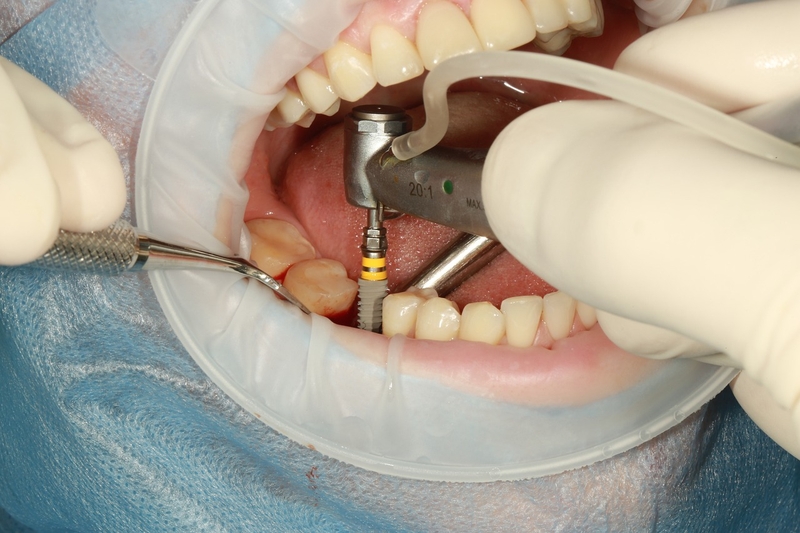 Trồng răng Implant có gây mê không? Những trường hợp nên cân nhắc trồng Implant gây mê 1