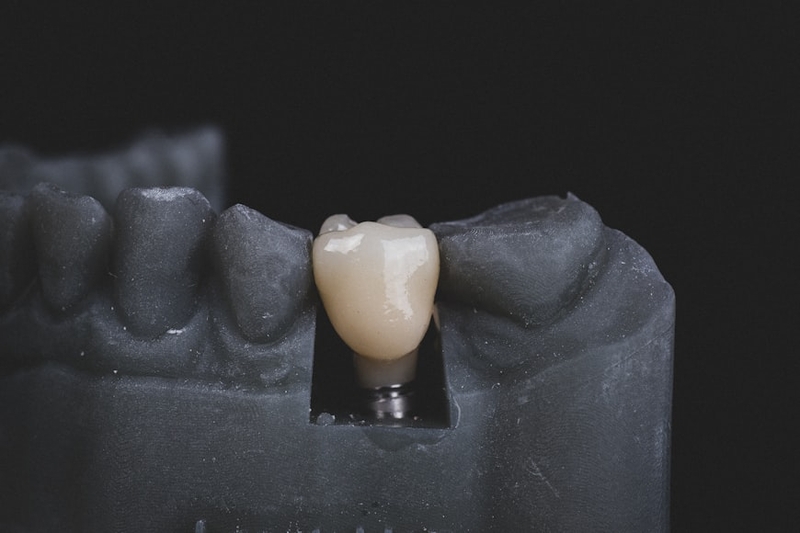 Trồng răng Implant có gây mê không? Những trường hợp nên cân nhắc trồng Implant gây mê 3