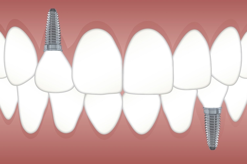 Trồng răng Implant có vĩnh viễn không? 1