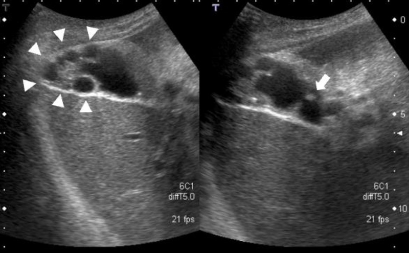 U cơ tuyến túi mật: Nguyên nhân, triệu chứng, chẩn đoán và điều trị 1