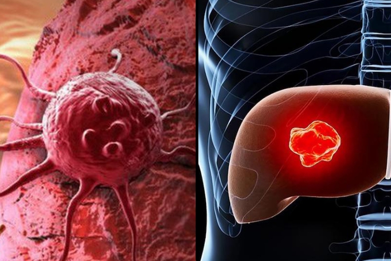 U gan ác tính sống được bao lâu? 2