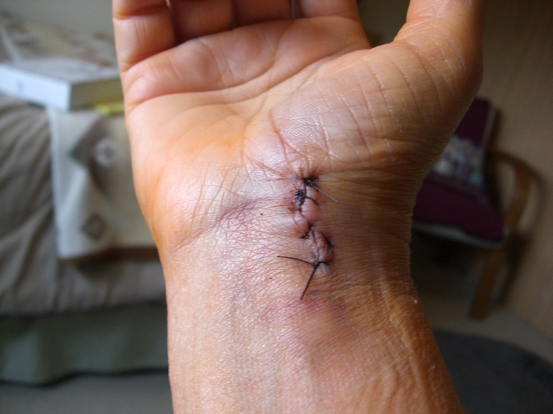 U nang hạch là gì? Nguyên nhân, triệu chứng và biện pháp điều trị hiệu quả 4