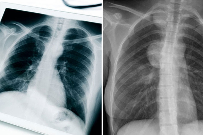 U trung thất ác tính sống được bao lâu? Cách điều trị và phòng ngừa 2