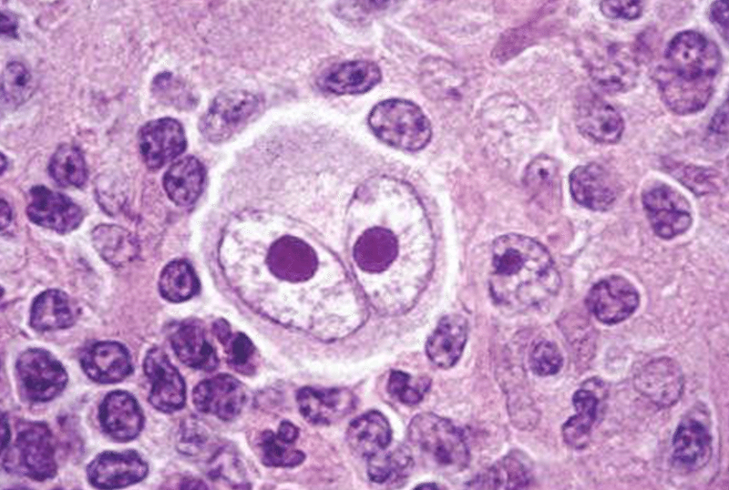 Ung thư hạch bạch huyết giai đoạn cuối: Dấu hiệu phân biệt 1