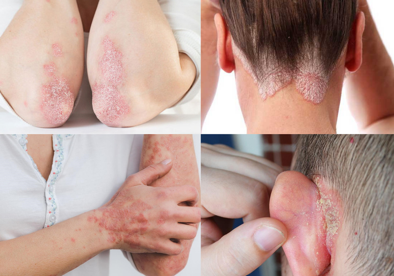 Vẩy nến nhẹ là gì? Có bao nhiêu phương pháp điều trị bệnh vảy nến nhẹ? 1