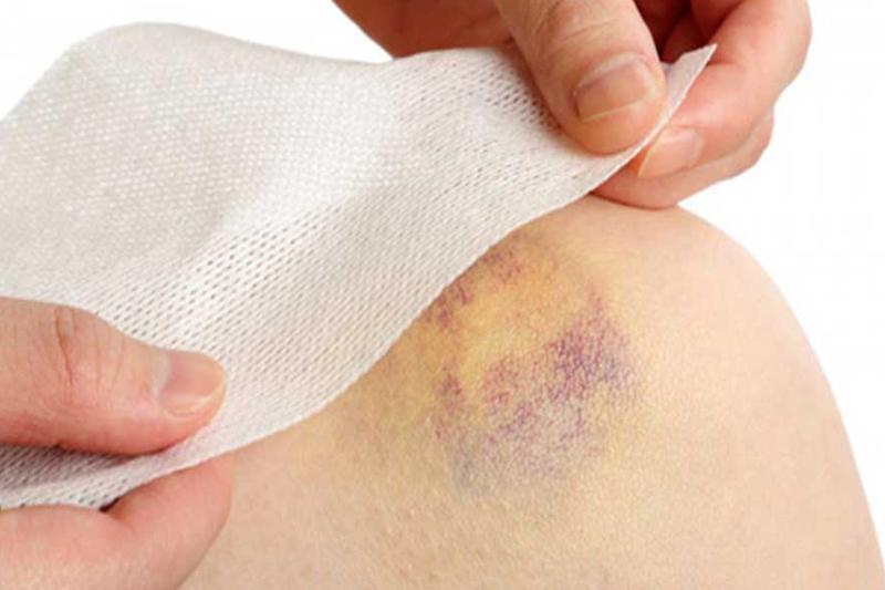 Vết bầm vàng trên da là dấu hiệu của bệnh gì? 1