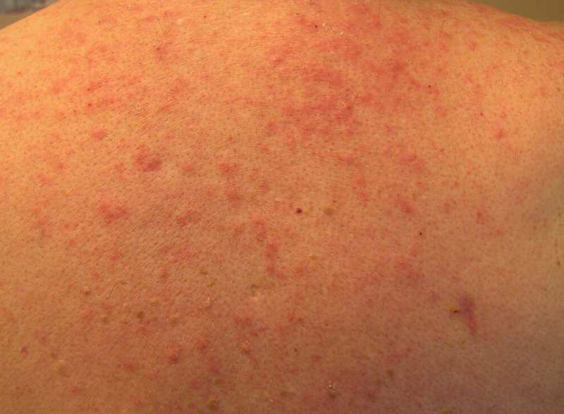 Viêm da mủ: Nguyên nhân gây bệnh và lưu ý khi điều trị 1