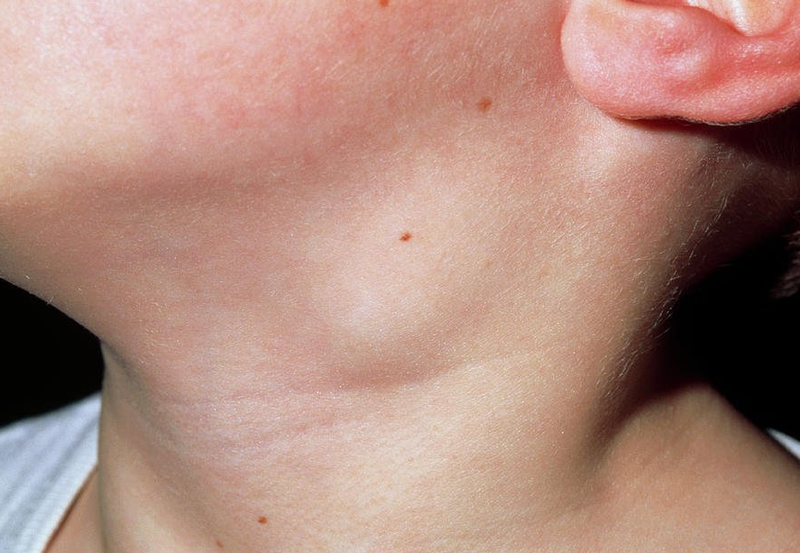 Viêm hạch bạch huyết ở trẻ em là bệnh gì? 2