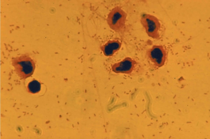 bai-viet/viem-mang-nao-mu-do-hib-la-gi-cach-phong-tranh-hieu-qua.html 1