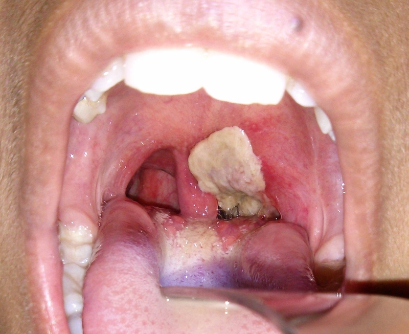 Xét nghiệm bạch hầu để làm gì? Khi nào nên xét nghiệm? 2