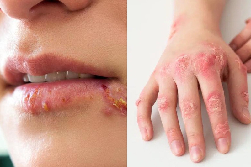 Xét nghiệm giang mai bao nhiêu tiền? Có được hưởng bảo hiểm y tế không? 1