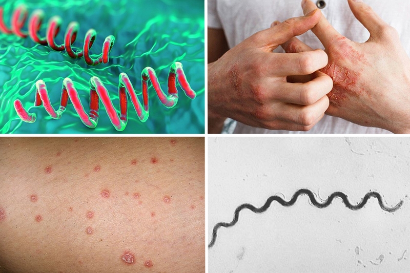 Xét nghiệm giang mai bao nhiêu tiền? Có được hưởng bảo hiểm y tế không? 2