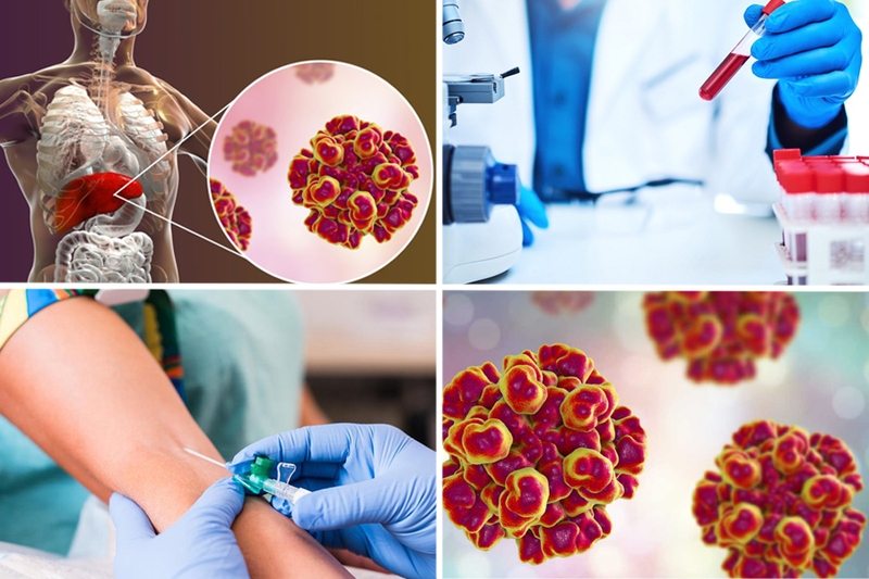 Xét nghiệm HEV là gì? Sự cần thiết và ứng dụng của xét nghiệm HEV 3