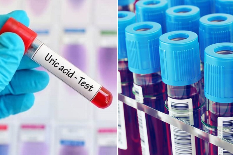 Xét nghiệm sinh hóa máu acid uric chẩn đoán bệnh gì? Hướng dẫn ngăn ngừa mức acid uric tăng cao 1