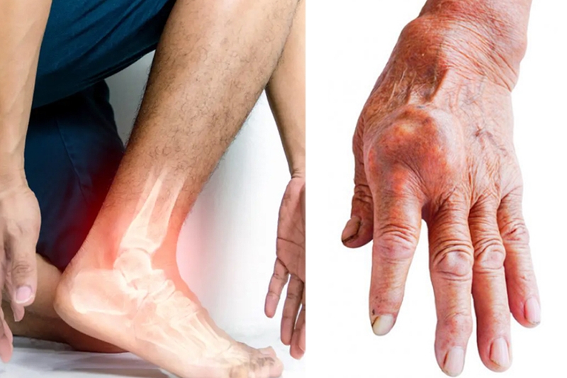 Xét nghiệm sinh hóa máu acid uric chẩn đoán bệnh gì? Hướng dẫn ngăn ngừa mức acid uric tăng cao 3