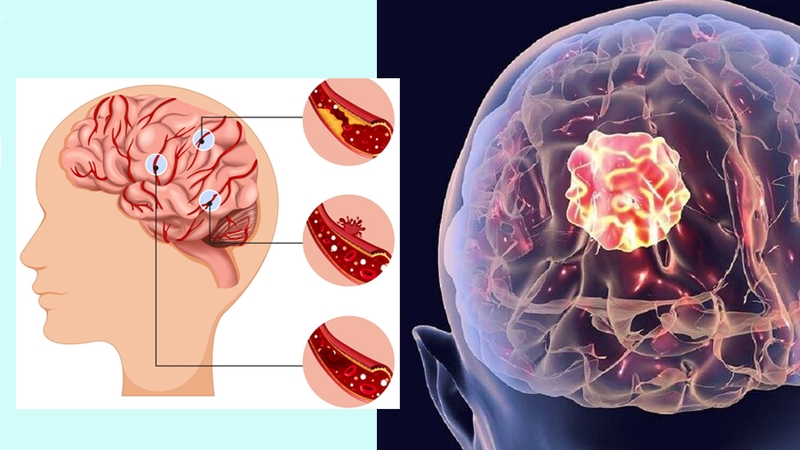 Xuất huyết nội sọ là gì? Có nguy hiểm không? 1