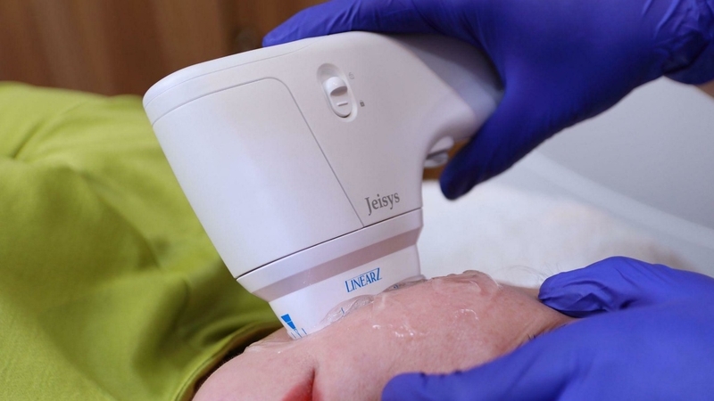 Bắn bao nhiêu số lượng Shots Hifu trong một liệu trình? 2