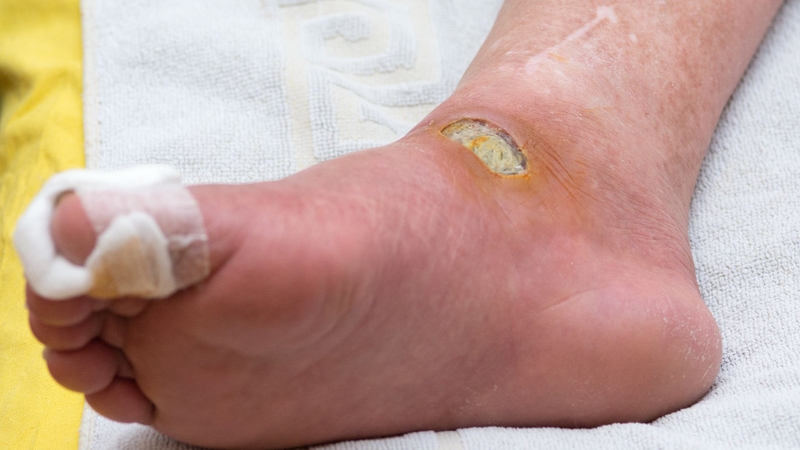 Bàn chân đái tháo đường: Nguyên nhân, dấu hiệu và cách phòng ngừa hiệu quả 2