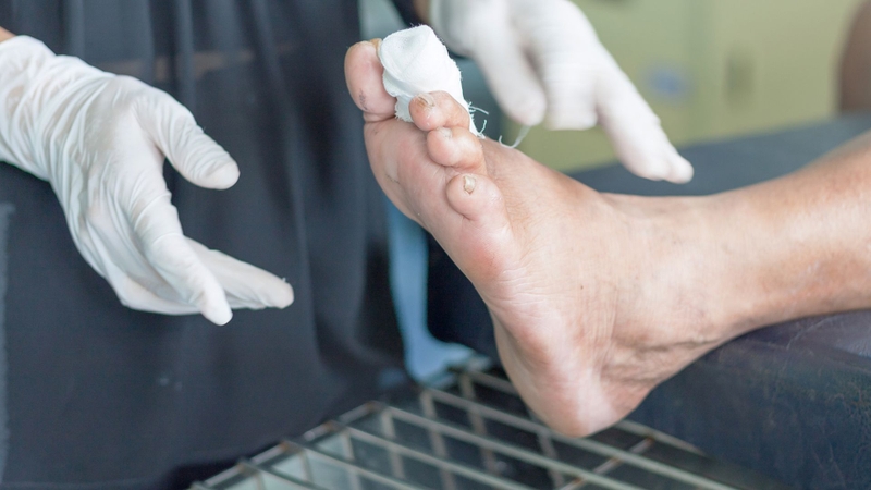 Bàn chân đái tháo đường: Nguyên nhân, dấu hiệu và cách phòng ngừa hiệu quả 4