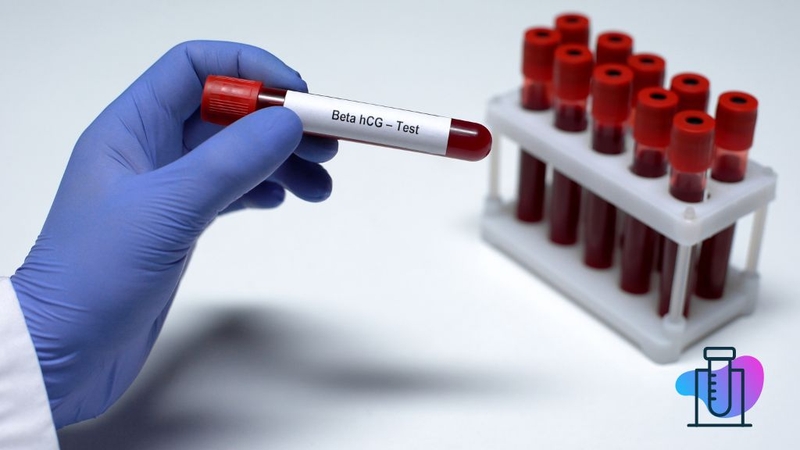 ban-co-biet-cach-doc-ket-qua-xet-nghiem-beta-h-cg-dung-cach-chua 2