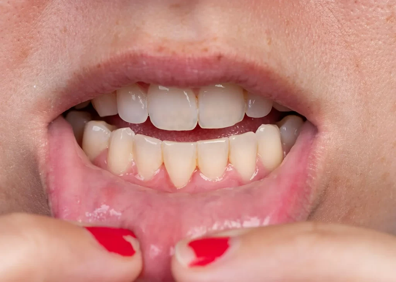 Bạn có muốn biết cách đánh răng không bị tụt lợi hay không?2