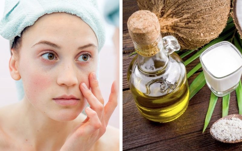Bạn đã biết cách trị quầng thâm mắt bằng dầu dừa chưa?2