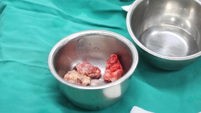 Bạn đã biết gì về phương pháp cắt amidan bằng máy coblator?