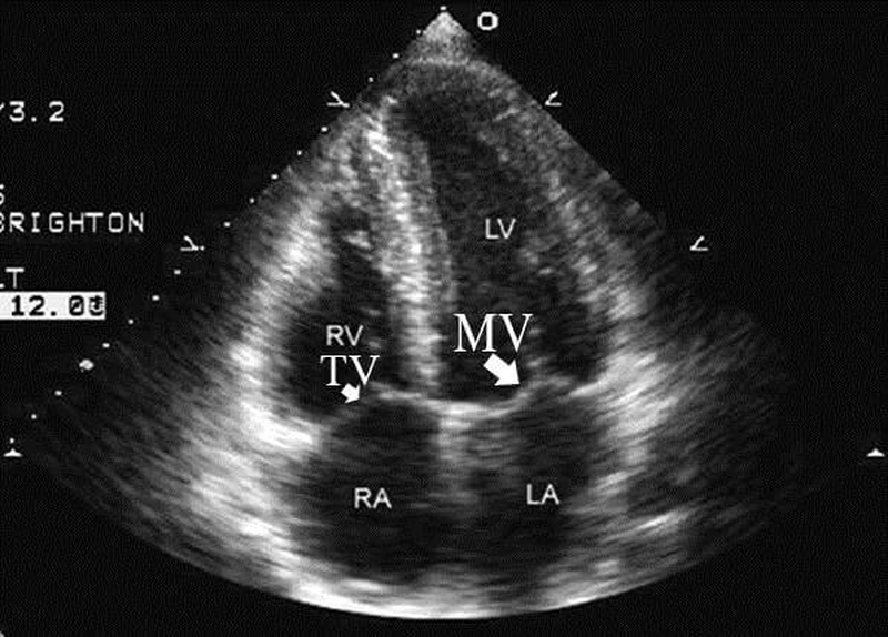 Bạn đã biết về siêu âm tim cơ bản hay chưa? 3