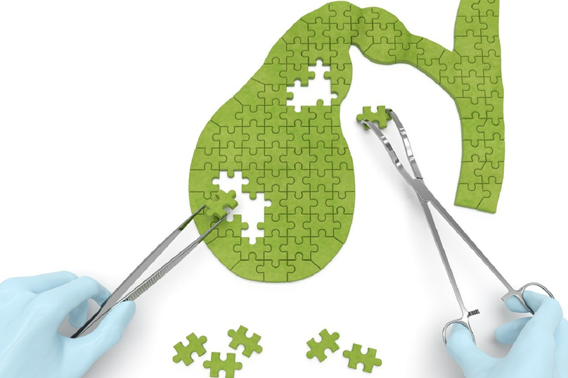 Bạn không nên chủ quan khi bị viêm túi mật mạn tính1