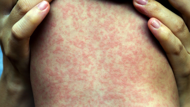 Sự khác nhau giữa ban sởi và ban rubella 1