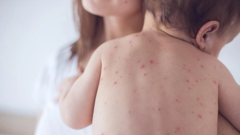 Sự khác nhau giữa ban sởi và ban rubella 4