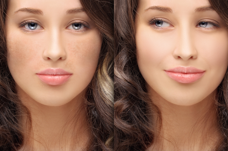 Bắn tàn nhang bao nhiêu tiền? Quy trình thực hiện bắn tàn nhang 3