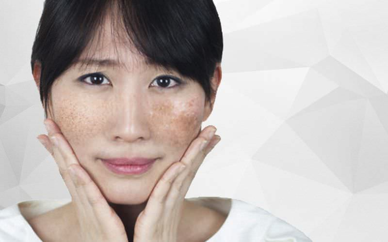 Bắn tàn nhang liệu có để lại thâm không? Cách khắc phục như thế nào?