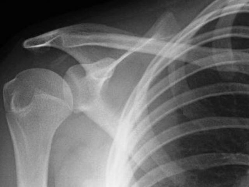 Bán trật khớp vai là gì