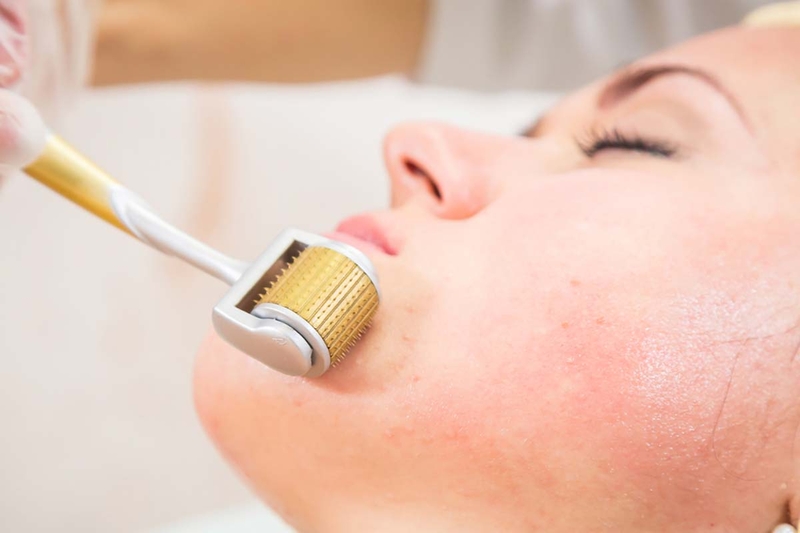 Bao lâu lăn kim 1 lần? Lăn kim nhiều lần có tốt không?-3