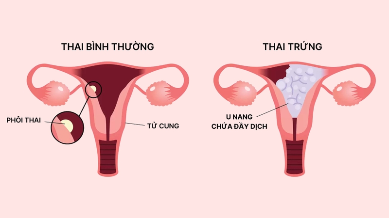 Thai trứng là một rối loạn phát triển bất thường của nhau thai trong thai kỳ