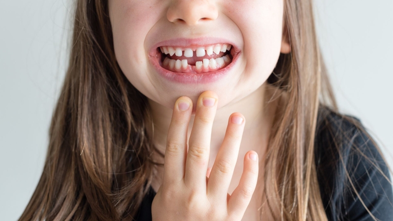 Bao nhiêu tuổi thì hết thay răng? Những điều cần lưu ý để răng vĩnh viễn mọc đều đẹp4
