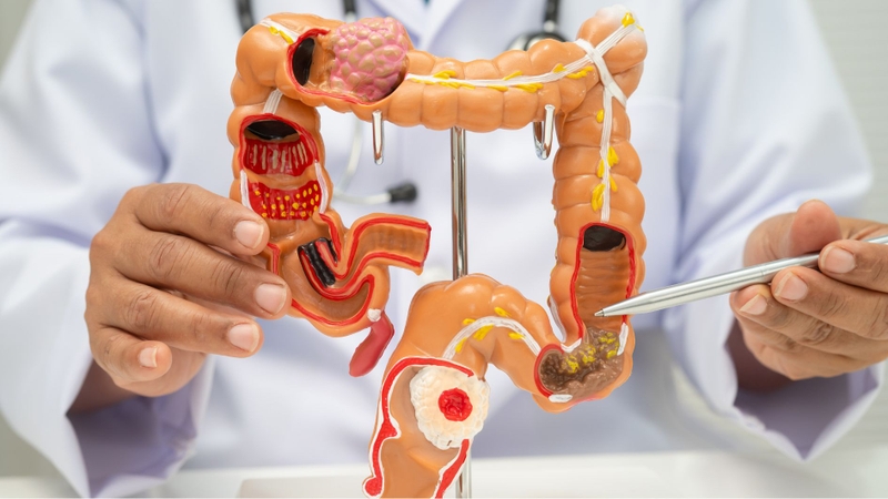 Phát hiện sớm ung thư tiêu hóa giúp tăng cơ hội điều trị thành công và kéo dài thời gian sống