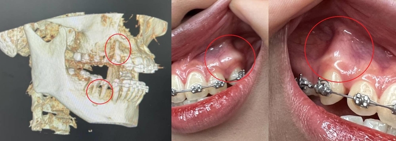 Bật chân răng ảnh hưởng như thế nào? -1