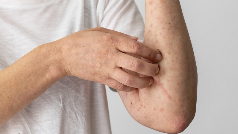 Bật mí 10 cách trị viêm nang lông đơn giản tại nhà 2