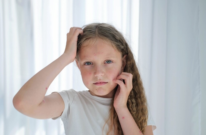 Bật mí 4 cách phòng tránh thủy đậu hiệu quả không phải ai cũng biết 1