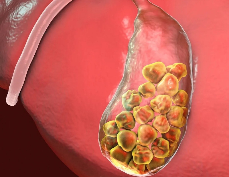 Bật mí 4 cách trị sỏi túi mật tại nhà không phải ai cũng biết 1