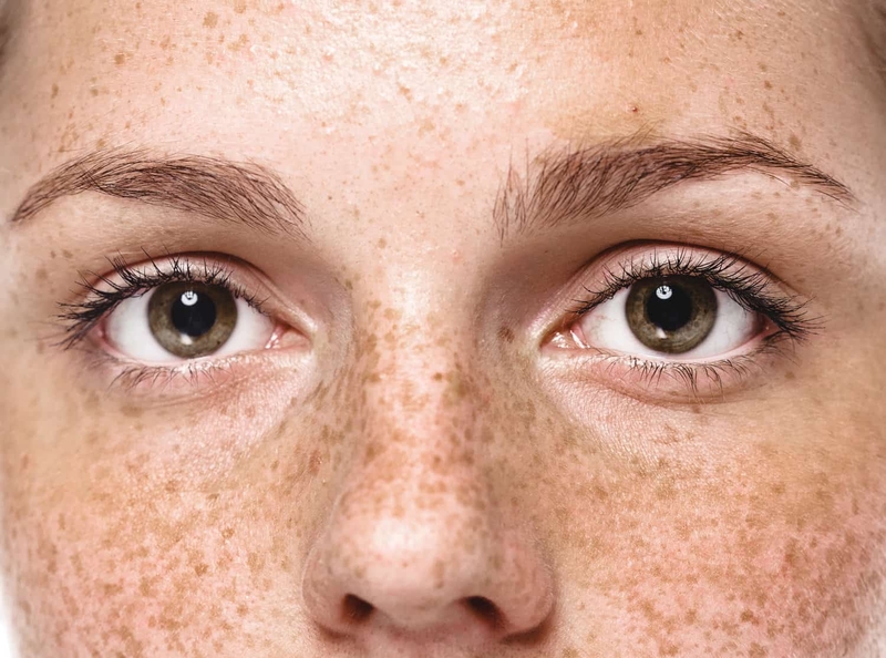 Bật mí 5 mẹo trị đồi mồi bằng dầu dừa cực đơn giản