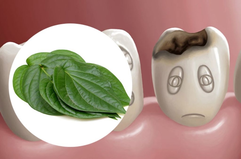 Cách chữa sâu răng hàm tại nhà bằng lá trầu không