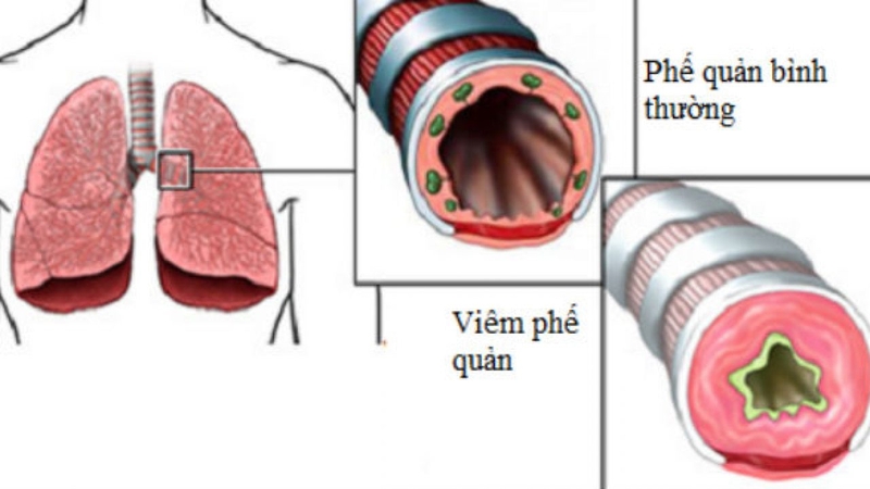 cách chữa viêm phế quản không dùng kháng sinh